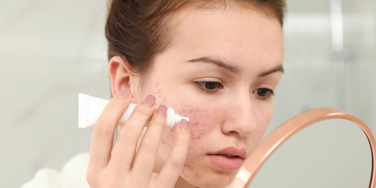 SOS acne: guida completa a cause, trattamenti, cure e rimedi