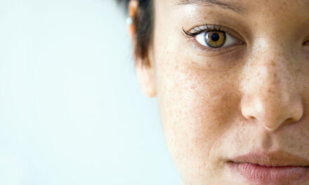 Iperpigmentazione e discromie del viso: i tips per contrastarle